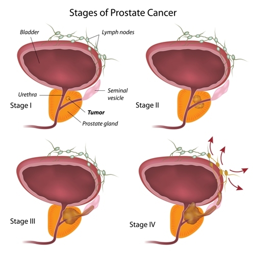 Prostate Cancer Stages