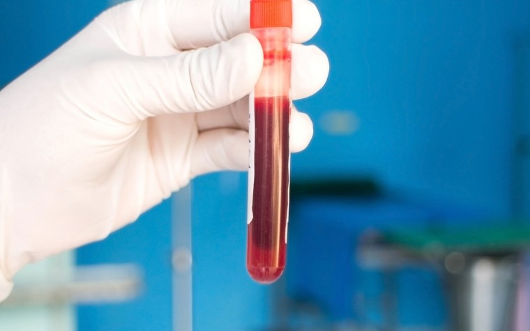 Prostate cancer blood test