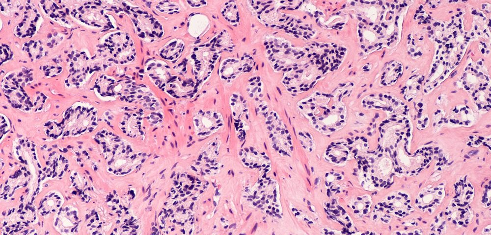 Cancer Can Change Tissue That Surrounds It, University of California Study Finds
