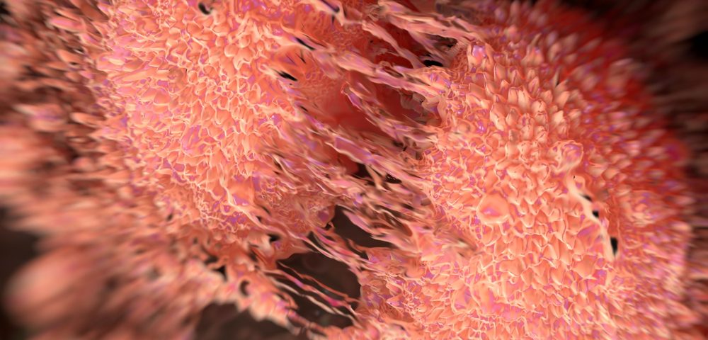 Model Captures ‘Spontaneous’ Cell Transition to Metastasis in Prostate Cancer Study