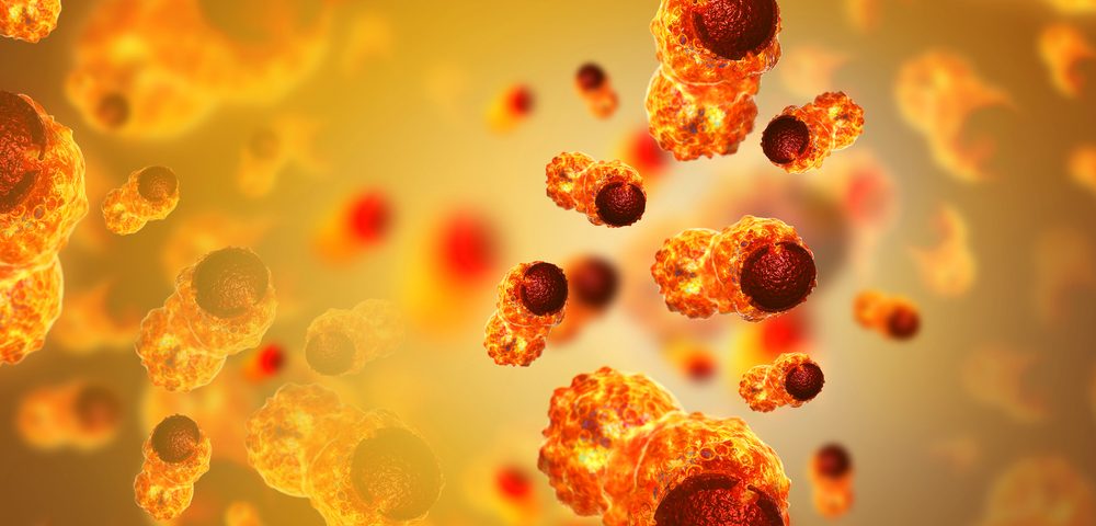 Trial Studies Gold Nanoparticles as Way to Eliminate Localized Prostate Cancer
